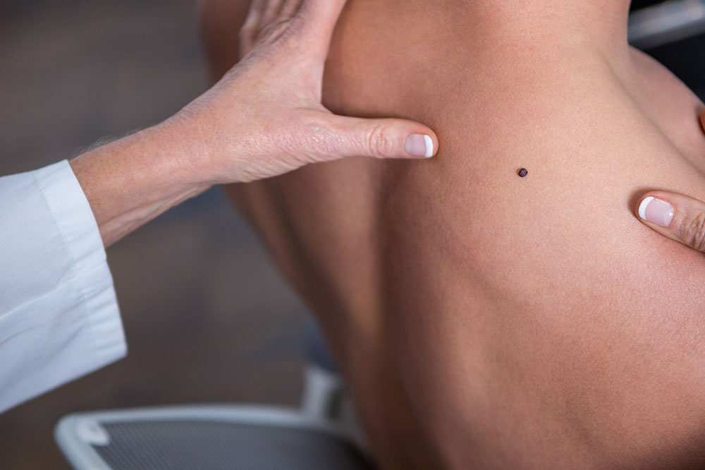 Melanoma – Early Warning Signs