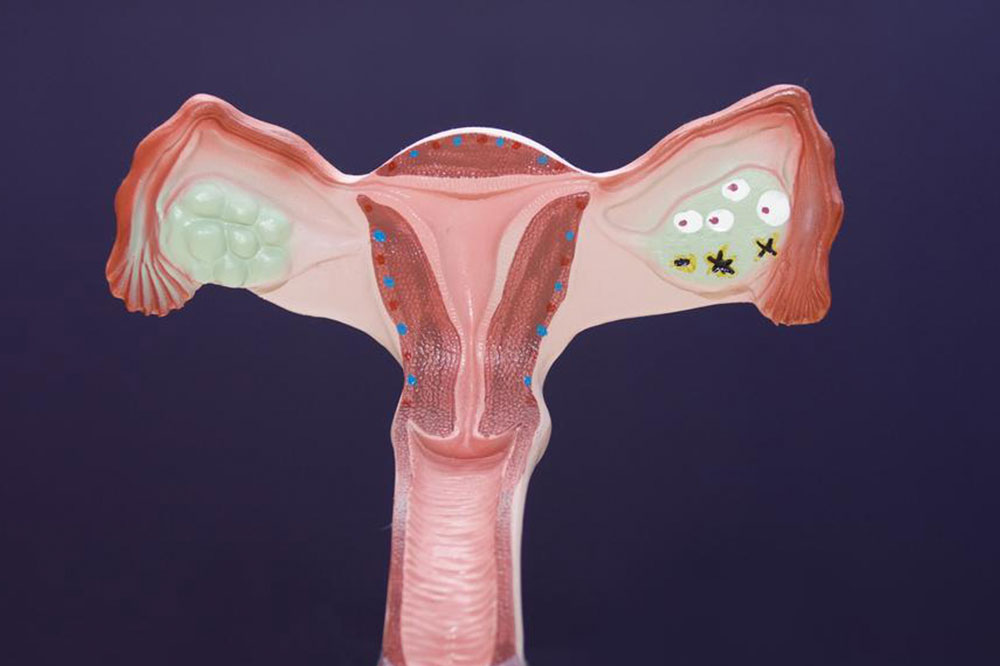 6 Early Warning Signs of Ovarian Cancer