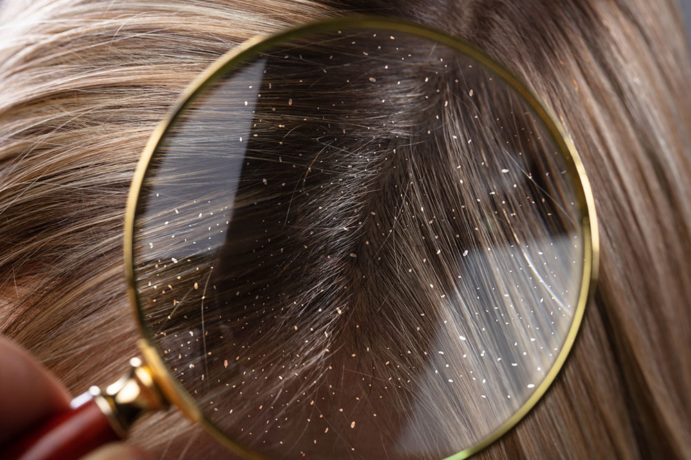 9 Home Remedies to Get Rid of Dandruff